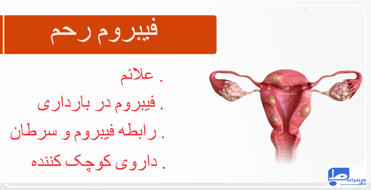 راه کوچک شدن فیبروم